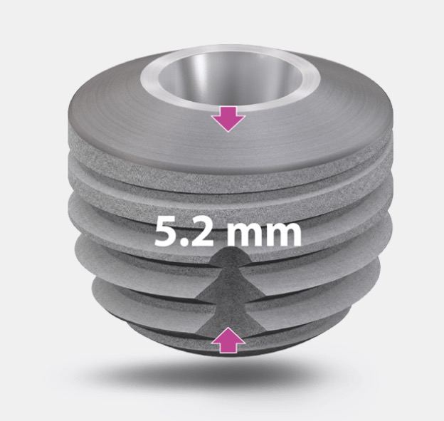 Copa sky implant (Untra Short) 5.2 mm